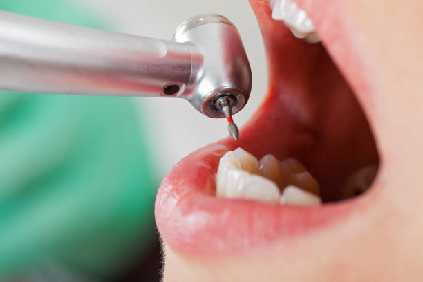 Best Urgent Care for Lost Fillings or Crowns in Paulsboro, NJ